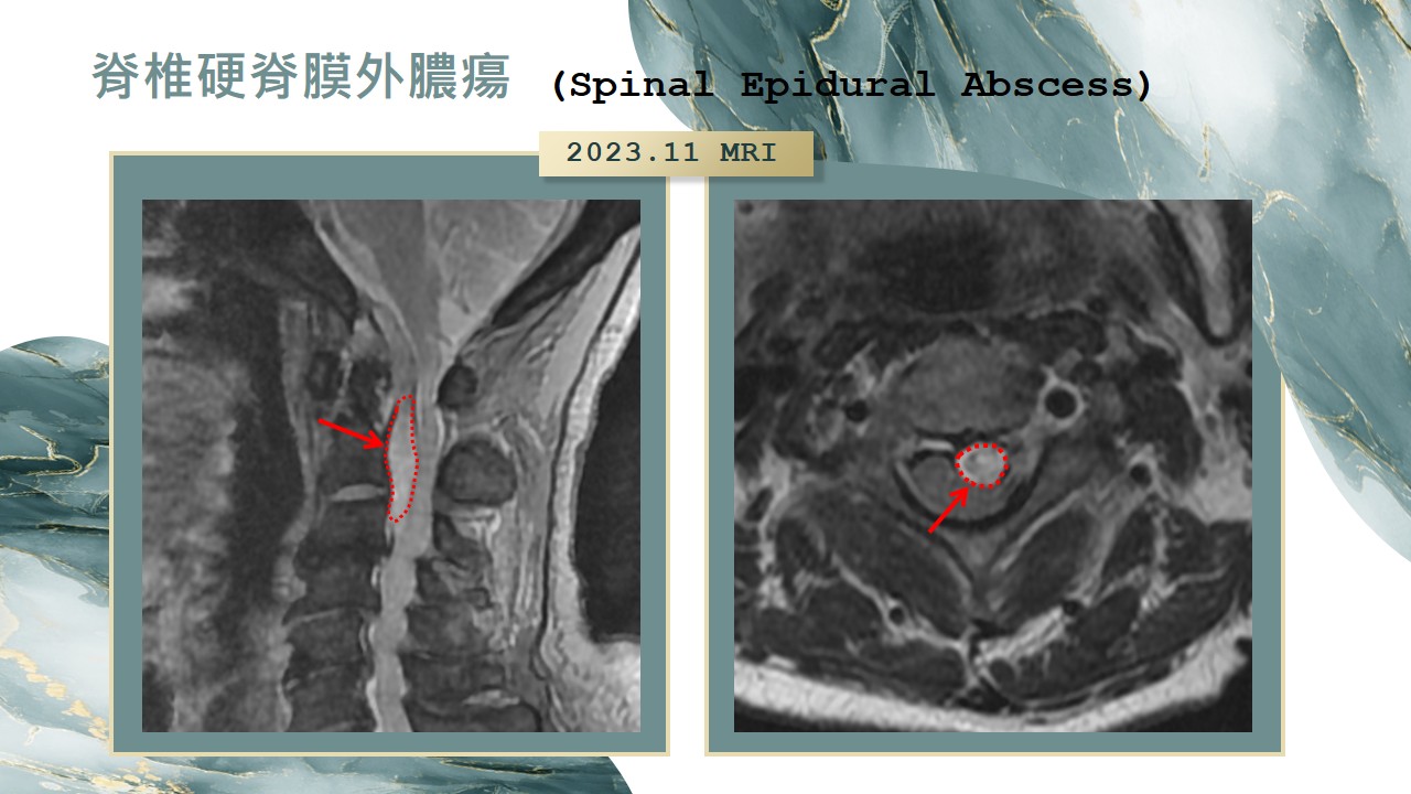 脊髓硬膜外膿腫影像